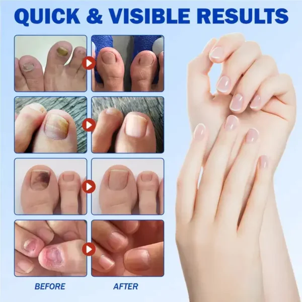 NESLEMY® Nail Fungus Care Patches