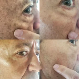 (🔥LAST DAY SALE-80% OFF)-Fast Dark Spot Remover-NESLEMY™  Turmeric Spot Repair Serum