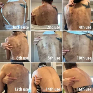 (🔥LAST DAY SALE-80% OFF)-Fast Dark Spot Remover-NESLEMY™  Turmeric Spot Repair Serum