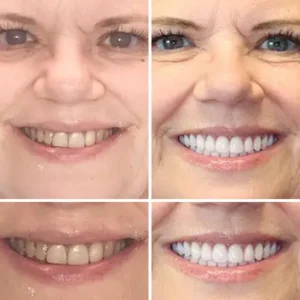 NESLEMY™ --🦷Advanced Customized Full Denture Set🦷™ --🦷Advanced Customized Full Denture Set🦷