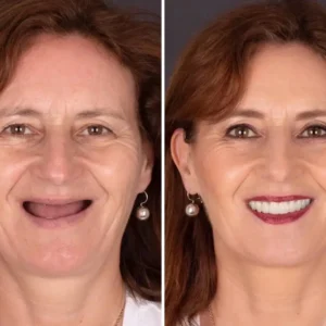 NESLEMY® BioFusion Dentures🦷Suitable for all mouth shapes, perfect fit🦷