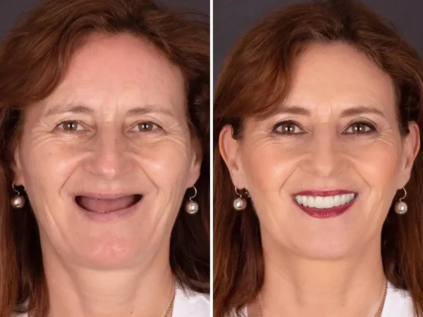 NESLEMY® BioFusion Dentures🦷Suitable for all mouth shapes, perfect fit🦷