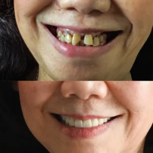 NESLEMY® BioFusion Dentures🦷Suitable for all mouth shapes, perfect fit🦷