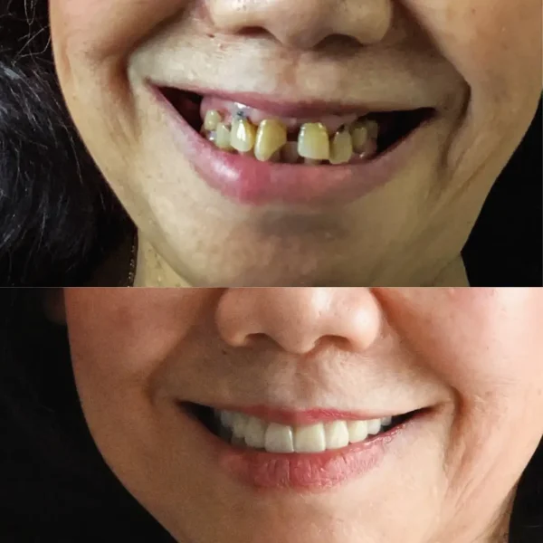 NESLEMY® BioFusion Dentures🦷Suitable for all mouth shapes, perfect fit🦷