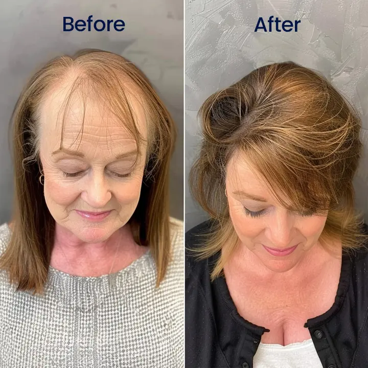 Neslemy® Maximum Strength 5% Minoxidil Fast-Action Hair Growth Serum