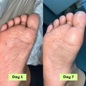 NESLEMY® AntiFungal Relief Soap Bar