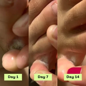 NESLEMY® AntiFungal Relief Soap Bar