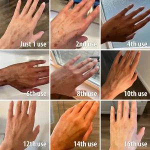 🔥Final 3 hours 60% off: ✨Fast Dark Spot Remover-NESLEMY™ Melanin Correcting Facial Serum!