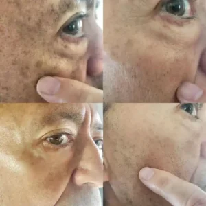 🔥Final 3 hours 60% off: ✨Fast Dark Spot Remover-NESLEMY™ Melanin Correcting Facial Serum!