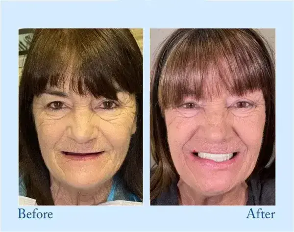 TrueEase™ Dentures