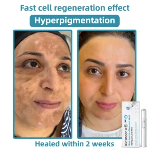 𝐓o𝐭a𝐥 𝐒𝐤𝐢𝐧 𝐂𝐨𝐧𝐟𝐢𝐝𝐞𝐧𝐜𝐞 𝐒𝐭𝐚𝐫𝐭𝐬 𝐇𝐞𝐫𝐞💎NESLEMY® 𝗡𝗼𝗻-𝗜𝗻𝘃𝗮𝘀𝗶𝘃𝗲 𝗠𝗼𝗜𝗲 𝗮𝗻𝗱 𝗪𝗮𝗿𝘁 𝗥𝗲𝗺𝗼𝘃𝗮𝗜 𝗜𝗮𝘀𝗲𝗿 𝗣𝗲𝗻