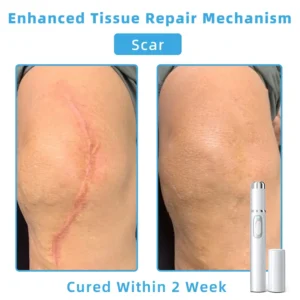 𝐓o𝐭a𝐥 𝐒𝐤𝐢𝐧 𝐂𝐨𝐧𝐟𝐢𝐝𝐞𝐧𝐜𝐞 𝐒𝐭𝐚𝐫𝐭𝐬 𝐇𝐞𝐫𝐞💎NESLEMY® 𝗡𝗼𝗻-𝗜𝗻𝘃𝗮𝘀𝗶𝘃𝗲 𝗠𝗼𝗜𝗲 𝗮𝗻𝗱 𝗪𝗮𝗿𝘁 𝗥𝗲𝗺𝗼𝘃𝗮𝗜 𝗜𝗮𝘀𝗲𝗿 𝗣𝗲𝗻