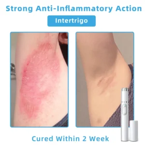 𝐓o𝐭a𝐥 𝐒𝐤𝐢𝐧 𝐂𝐨𝐧𝐟𝐢𝐝𝐞𝐧𝐜𝐞 𝐒𝐭𝐚𝐫𝐭𝐬 𝐇𝐞𝐫𝐞💎NESLEMY® 𝗡𝗼𝗻-𝗜𝗻𝘃𝗮𝘀𝗶𝘃𝗲 𝗠𝗼𝗜𝗲 𝗮𝗻𝗱 𝗪𝗮𝗿𝘁 𝗥𝗲𝗺𝗼𝘃𝗮𝗜 𝗜𝗮𝘀𝗲𝗿 𝗣𝗲𝗻