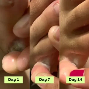 55% off NESLEMY® AntiFungal Relief Soap Bar