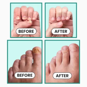 NESLEMY™ ClearNail Blue Light Device