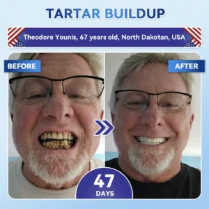 Your Smile~ NESLEMY® 🦷 Tideglusib Fast‑Dissolving Tooth & Gum Repair Oral Strips ✨ (𝟓-𝐢𝐧-𝟏 💎 𝐑𝐞𝐛𝐮𝐢𝐥𝐝 𝐄𝐧𝐚𝐦𝐞𝐥 & 𝐃𝐞𝐧𝐭𝐢𝐧 • 𝐒𝐭𝐫𝐞𝐧𝐠𝐭𝐡𝐞𝐧 𝐆𝐮𝐦𝐬 • 𝐄𝐫𝐚𝐝𝐢𝐜𝐚𝐭𝐞 𝐓𝐚𝐫𝐭𝐚𝐫 & 𝐎𝐝𝐨𝐫 • 𝐖𝐡𝐢𝐭𝐞𝐧𝐢𝐧𝐠 • 𝐒𝐭𝐨𝐩 𝐓𝐨𝐨𝐭𝐡 𝐒𝐞𝐧𝐬𝐢𝐭𝐢𝐯𝐢𝐭𝐲)