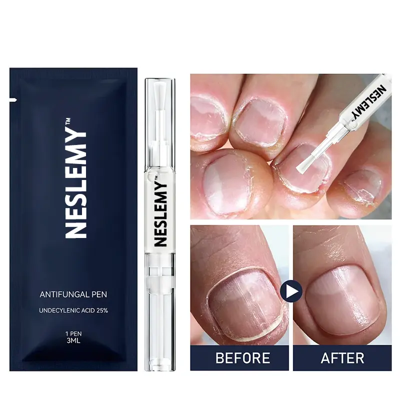 (⏳LAST DAY 70% OFF)NESLEMY™ Antifungal Pen – 25% Undecylenic Acid Treatment for Athlete’s Foot & Skin Fungus 🦶