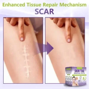 NESLEMY® Soluble Microneedle Botanical Skin Tag Removal Patch