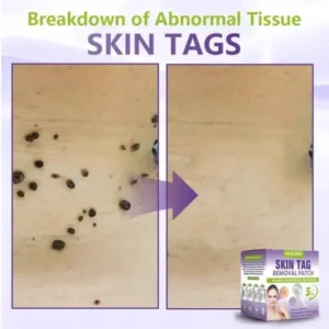 NESLEMY® Soluble Microneedle Botanical Skin Tag Removal Patch