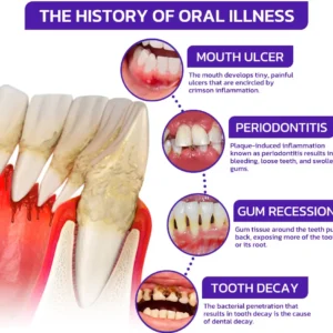 🔥Last Day 80% OFF 👨‍⚕️  NESLEMY® Bee Venom Dental Treatment Toothpaste