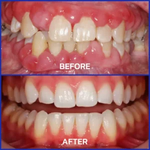 🔥Last Day 80% OFF 👨⚕️ NESLEMY® Bee Venom Dental Treatment Toothpaste