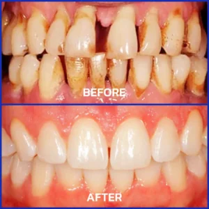 🔥Last Day 80% OFF 👨⚕️ NESLEMY® Bee Venom Dental Treatment Toothpaste