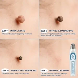 NESLEMY® 7-Day Skin Tag & Spot Eraser Painless & Scar-Free Advanced Imperfection Removal Rollerball Pen