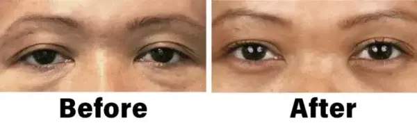 NESLEMY™ Nano Vision Repair Eye Serum ✅FDA Approved(Suitable for presbyopia, dry eye syndrome, glaucoma, and cataracts)