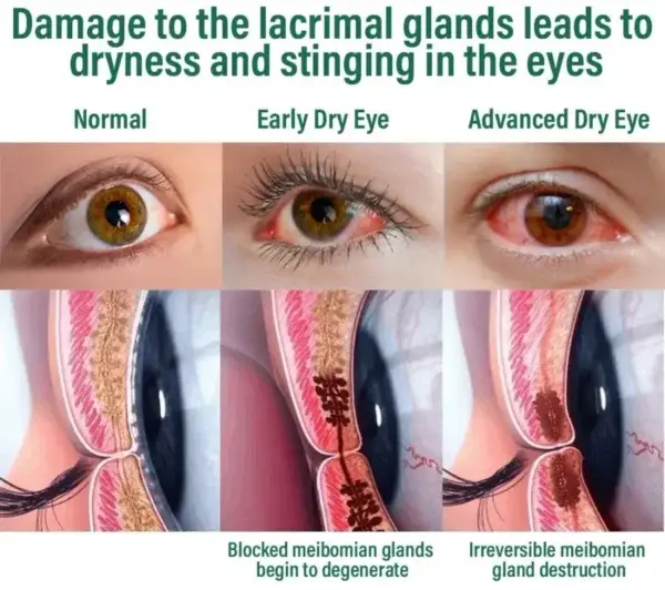 NESLEMY™ Nano Vision Repair Eye Serum ✅FDA Approved(Suitable for presbyopia, dry eye syndrome, glaucoma, and cataracts)